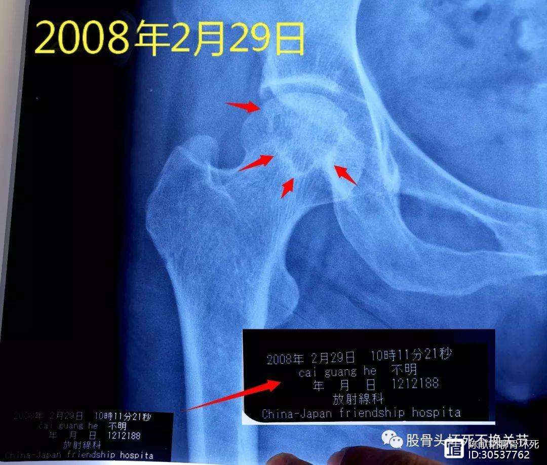 芜湖人工骨头医保报销多少(人工骨头医保报销多少比例)